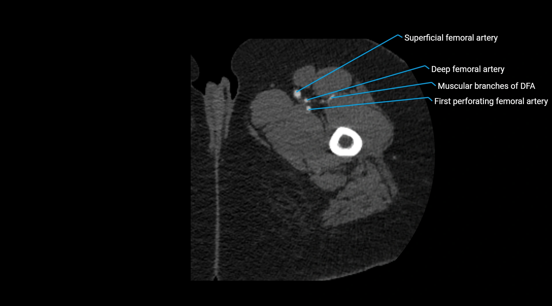 CTA lower limb cross sectional anatomy labelled image _85.webp